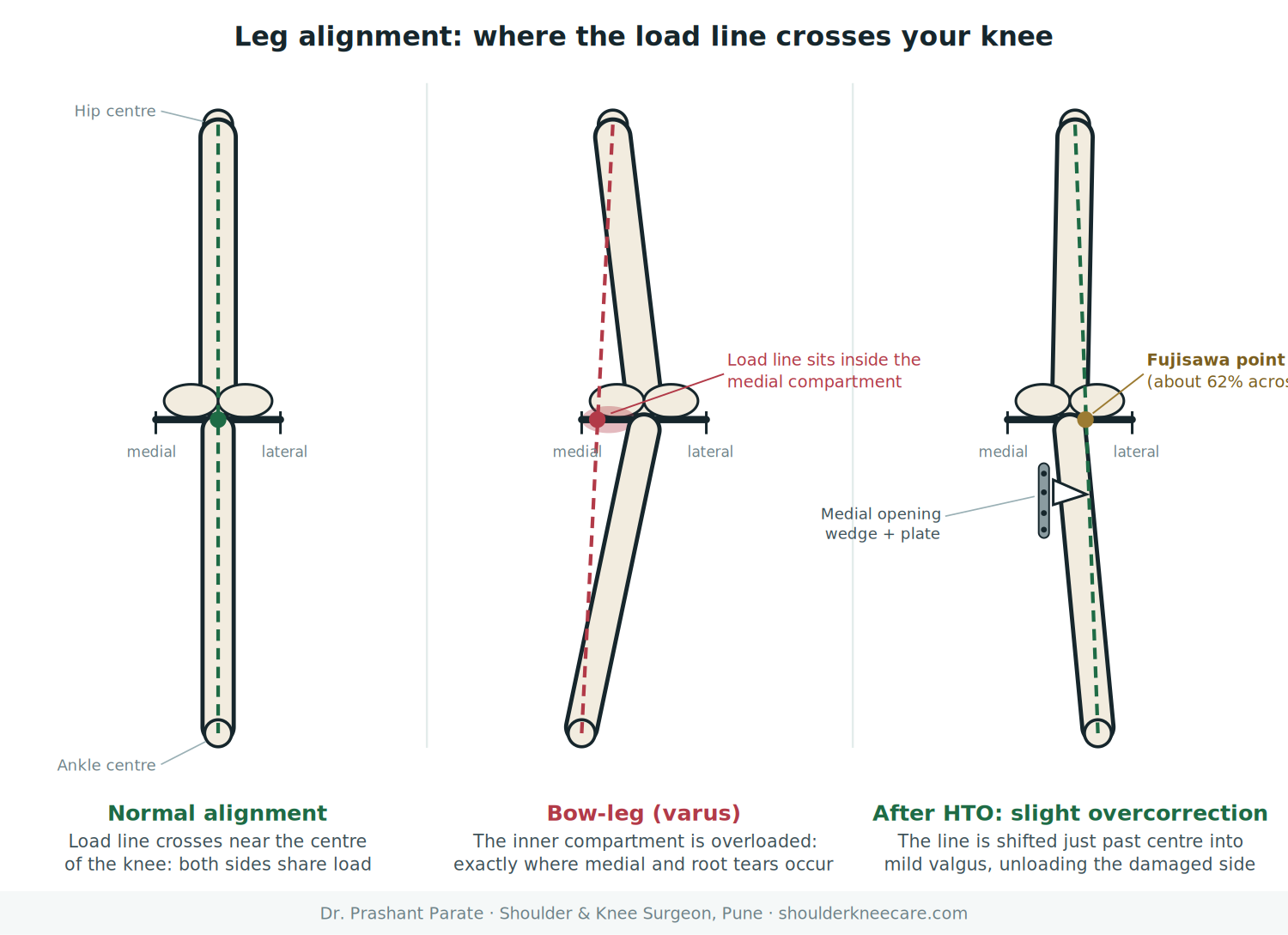 Varus knee alignment and high tibial osteotomy load line correction to the Fujisawa point