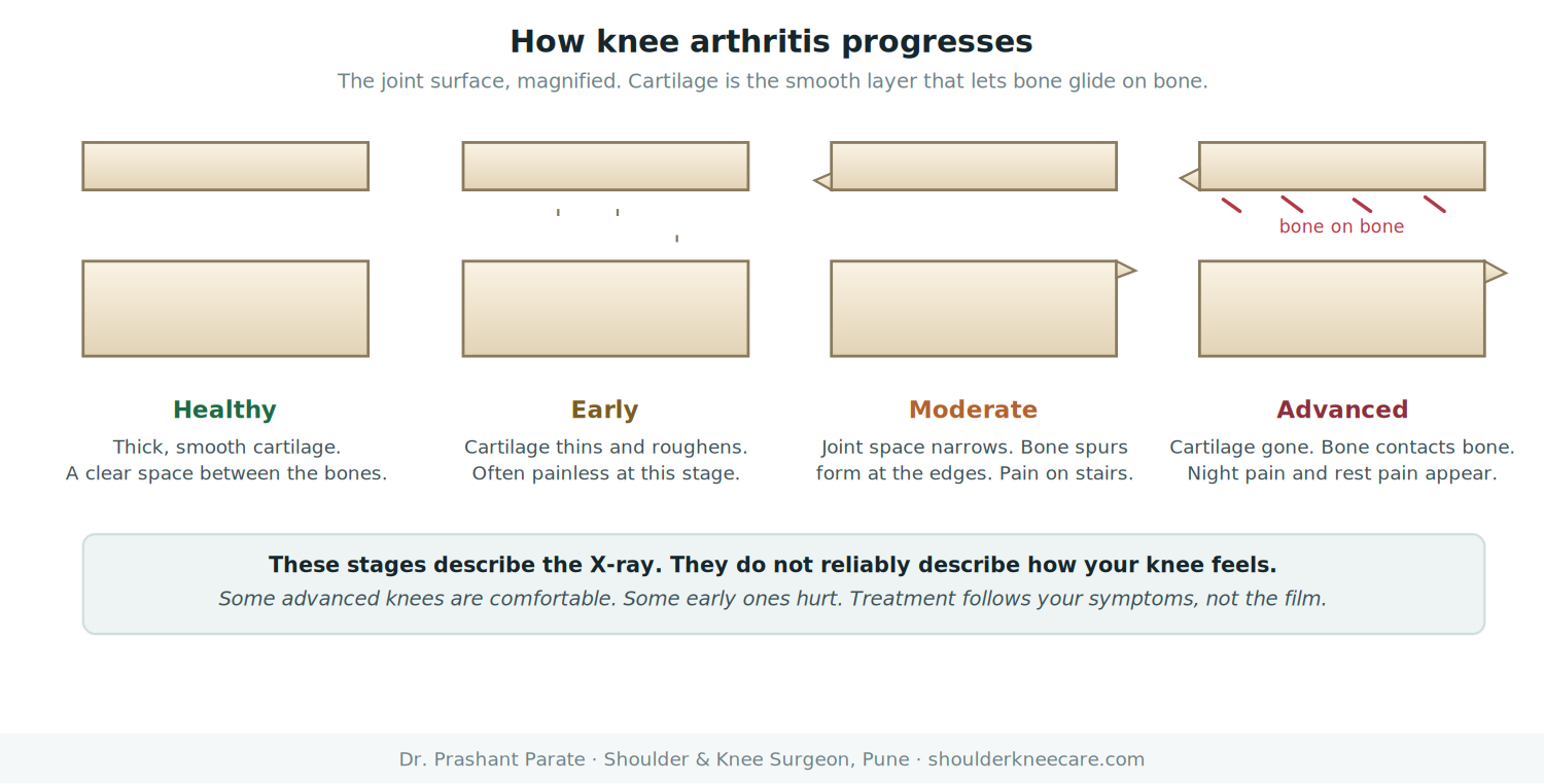 Stages of knee arthritis: healthy cartilage, early thinning, moderate joint space narrowing with bone spurs, and advanced bone on bone