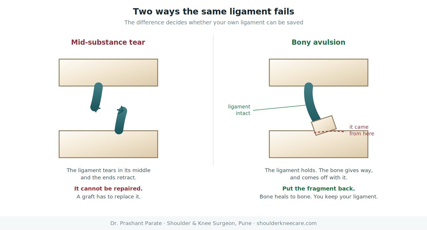 Mid-substance ligament tear compared with a bony avulsion where the ligament stays intact and pulls off with bone