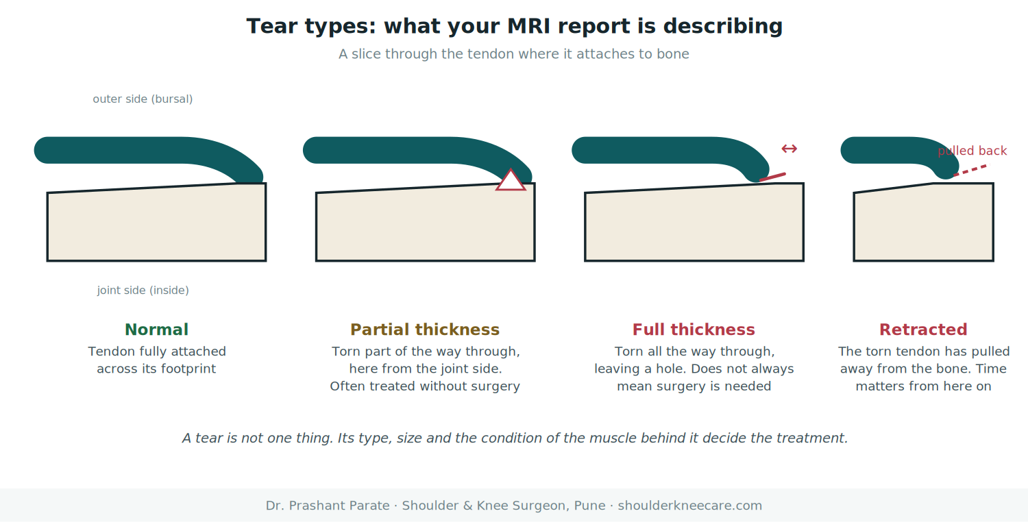 Rotator cuff tear types: partial thickness, full thickness and retracted tear