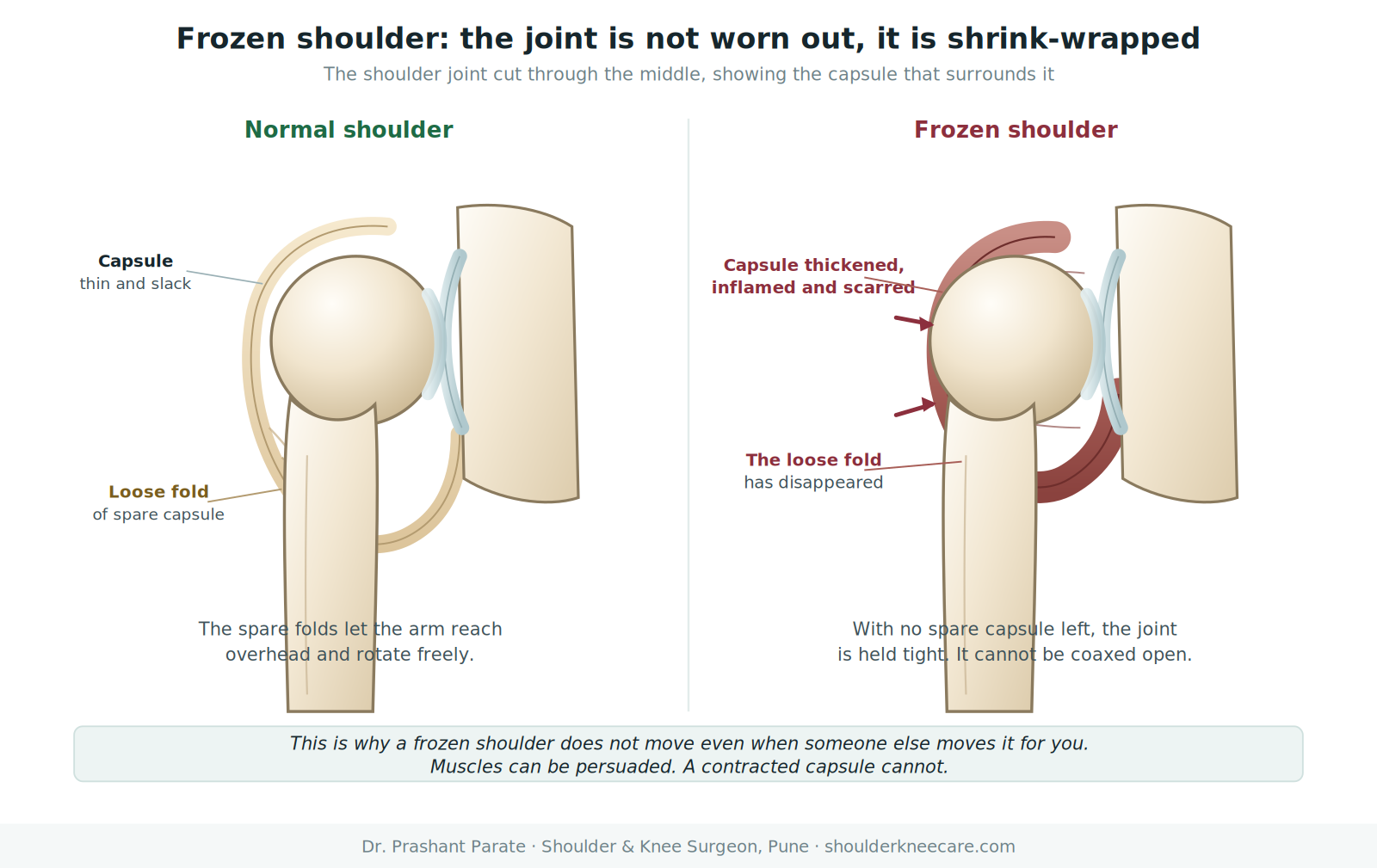 Frozen shoulder diagram: normal loose joint capsule compared with a thickened contracted capsule