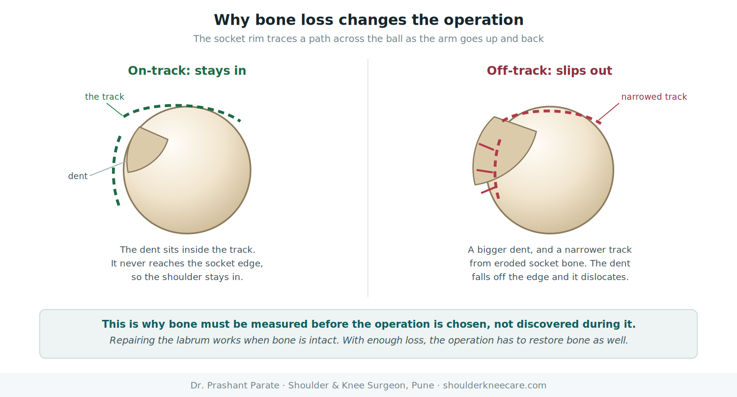 Glenoid bone loss and the glenoid track: on-track and off-track Hill-Sachs lesions in shoulder instability