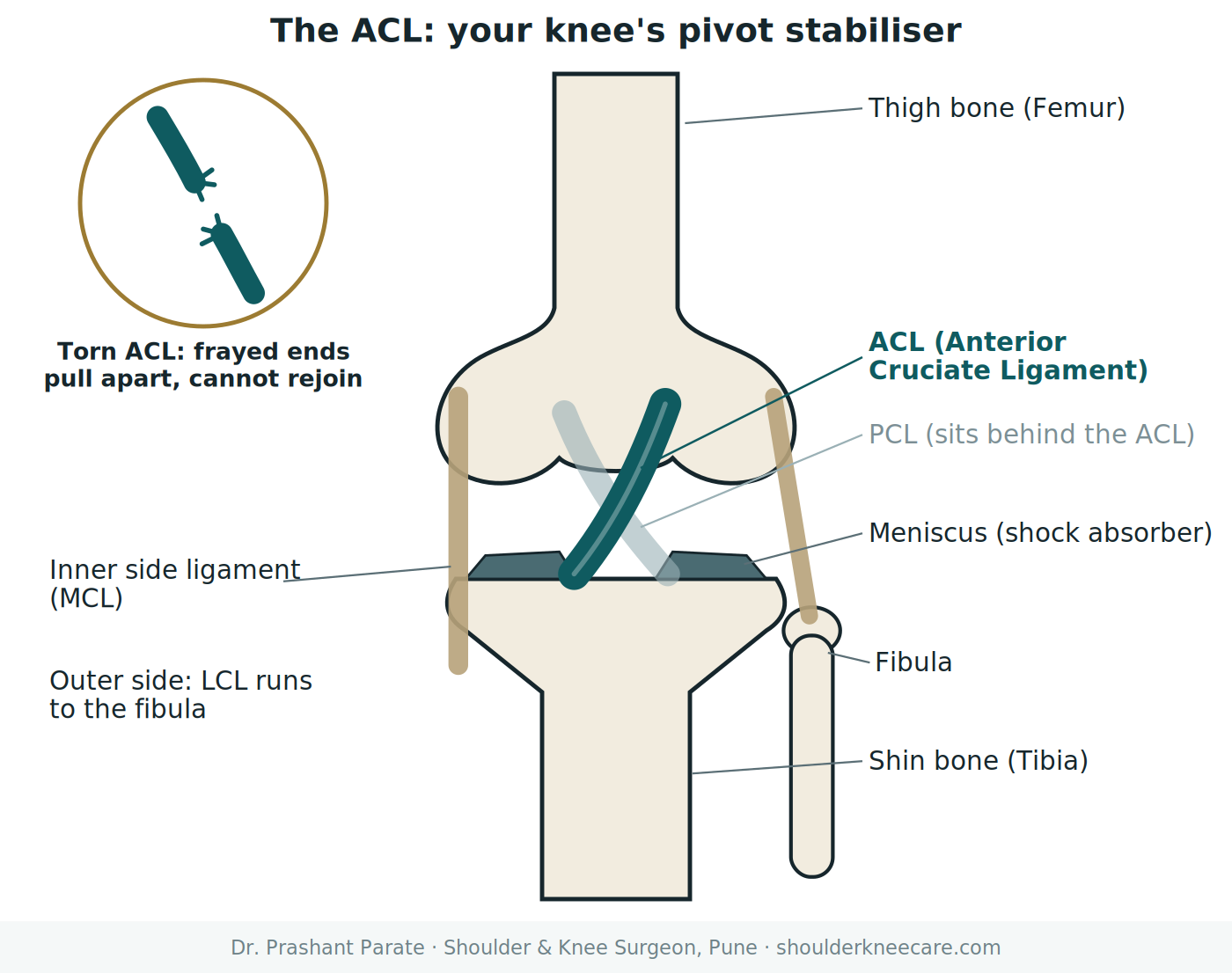 Knee anatomy diagram showing the ACL, PCL, meniscus and ligaments, by Dr. Prashant Parate, Pune