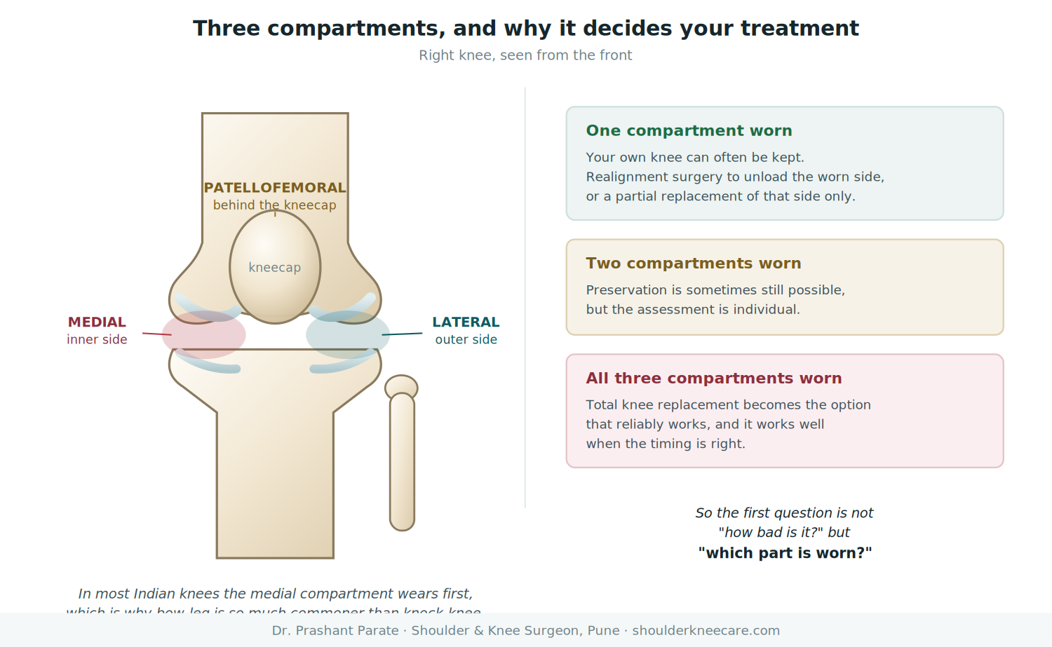 The three compartments of the knee: medial, lateral and patellofemoral, and how this decides between osteotomy, partial and total knee replacement