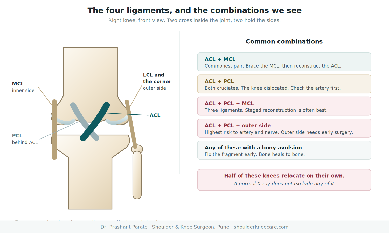 The four knee ligaments showing the MCL on the inner side and the LCL with the posterolateral corner on the outer side