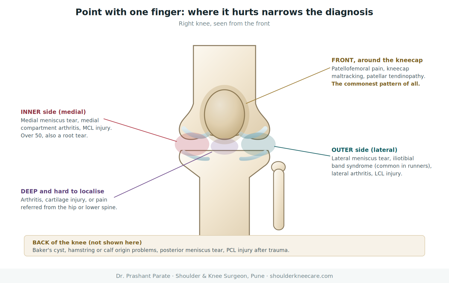 Knee pain location map: front, inner, outer, back and deep knee pain and what each location suggests