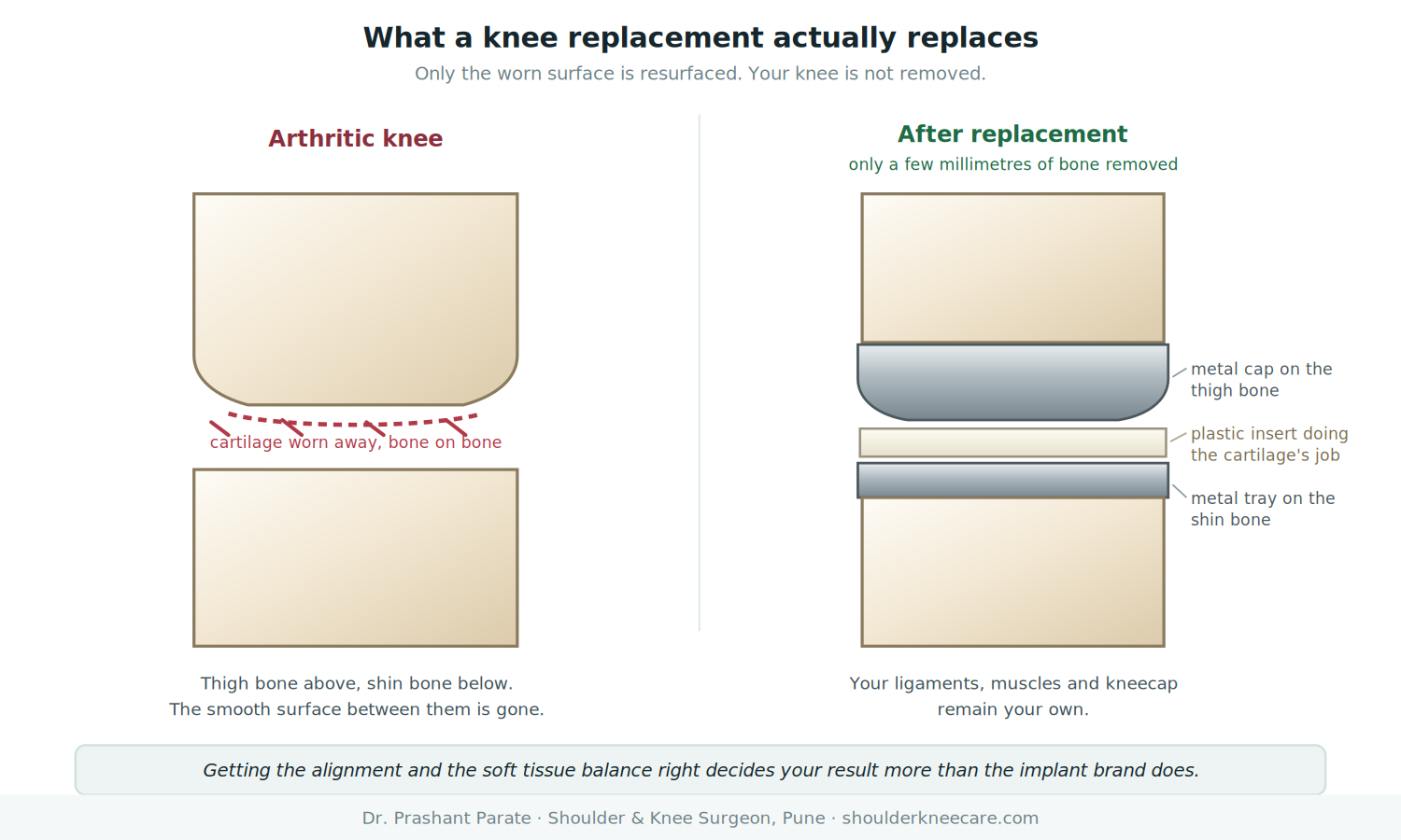 What a knee replacement actually replaces: worn surface resurfaced with metal caps and a plastic insert
