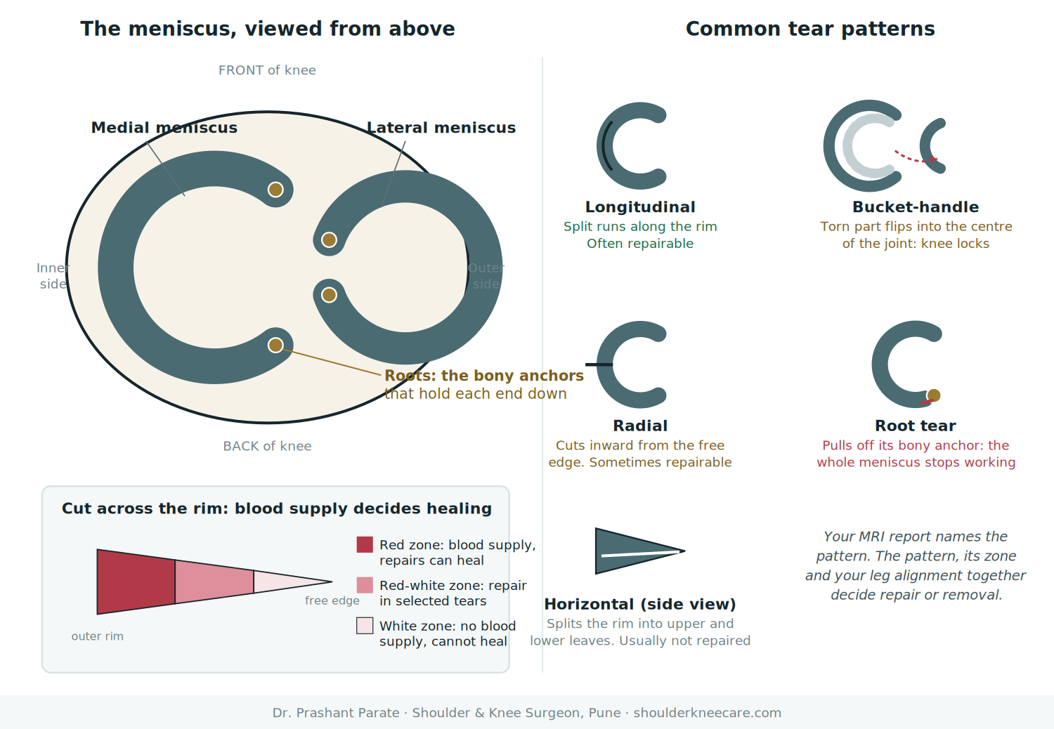 Meniscus blood supply zones and tear patterns diagram: red zone, white zone, bucket-handle and root tear