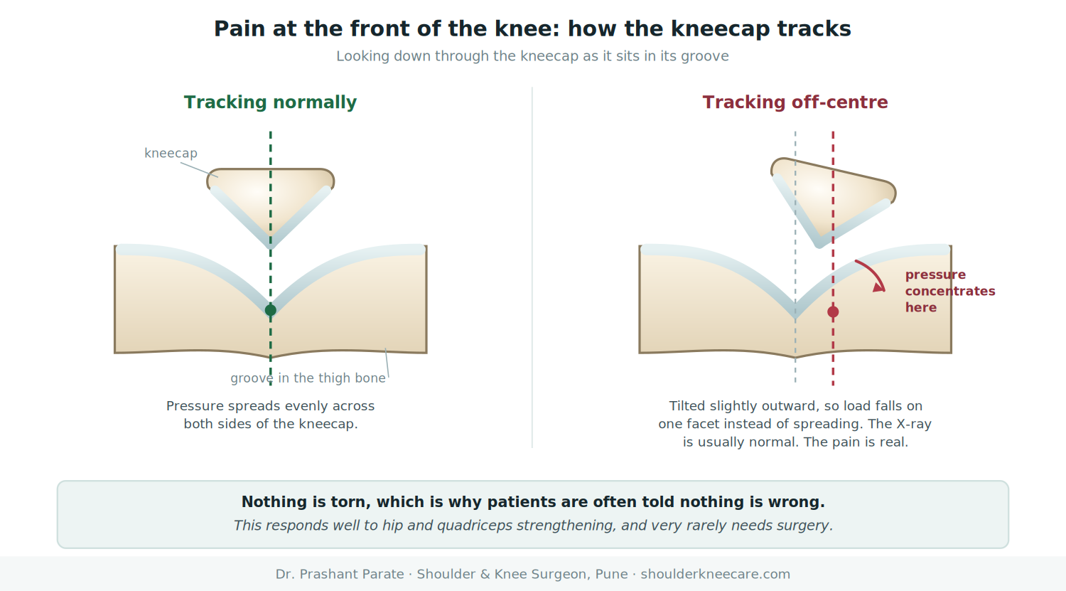 Patellofemoral pain: normal kneecap tracking compared with off-centre tracking concentrating pressure