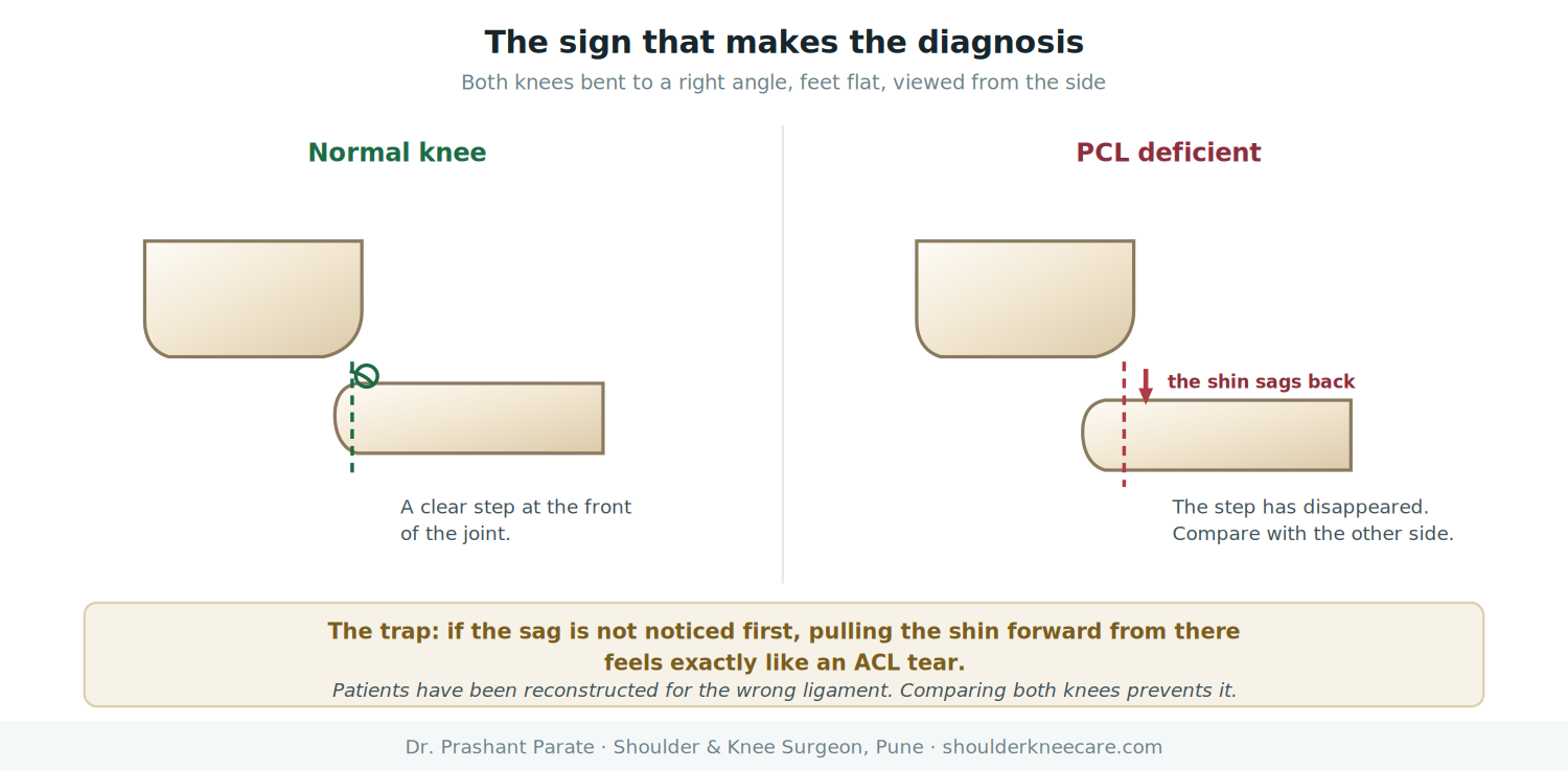 Posterior sag sign in PCL injury: the shin bone sags backwards compared with the normal knee