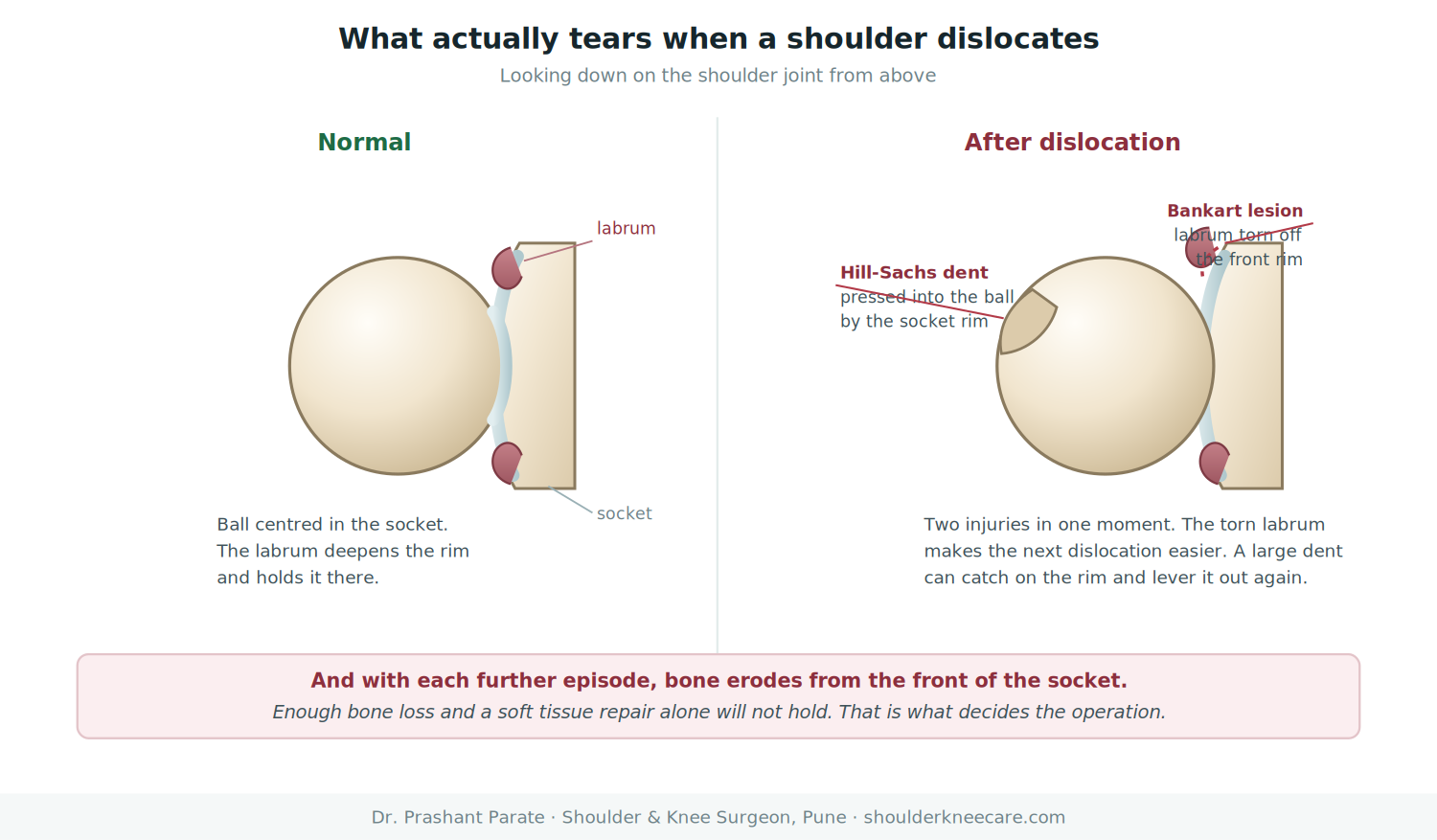 Shoulder dislocation anatomy: Bankart lesion of the labrum and Hill-Sachs dent in the humeral head