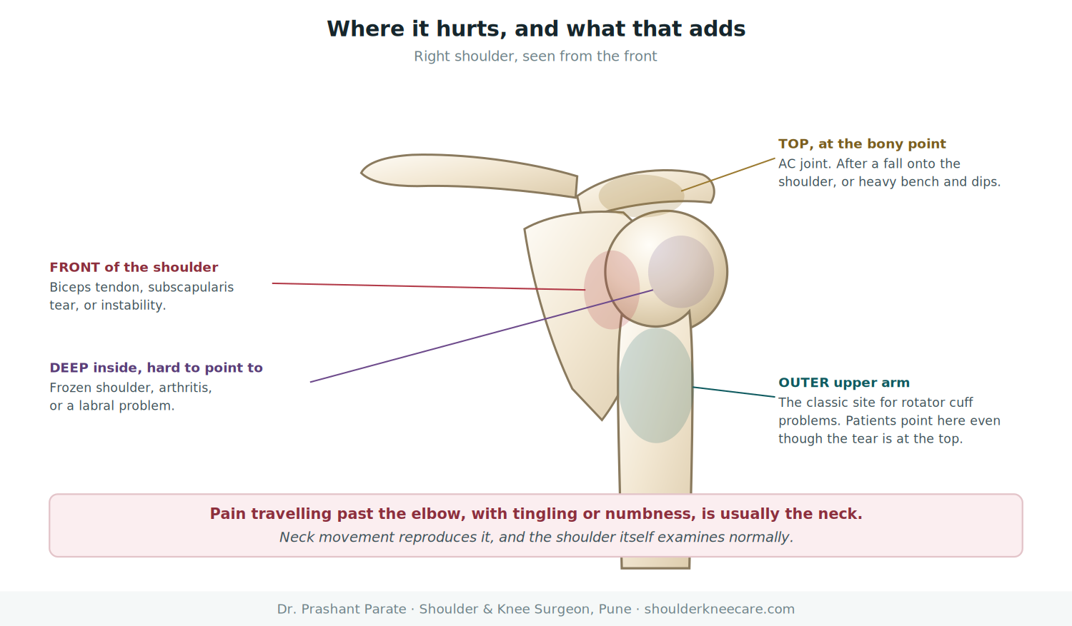 Shoulder pain location map: top of shoulder, outer arm, front and deep pain and what each location suggests
