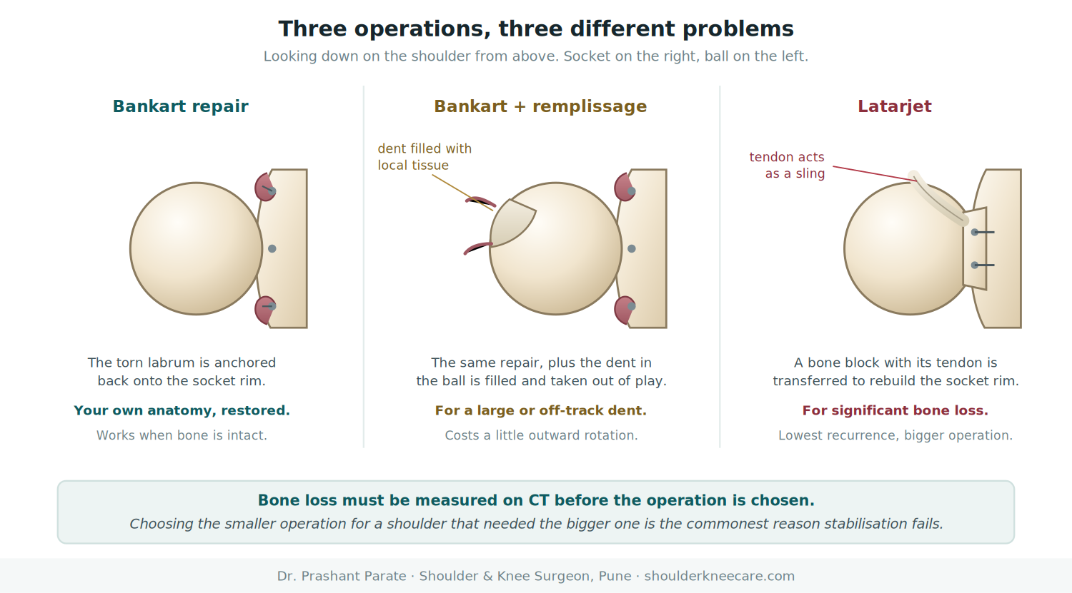 Bankart repair, Bankart with remplissage and Latarjet compared: what each operation does for shoulder instability